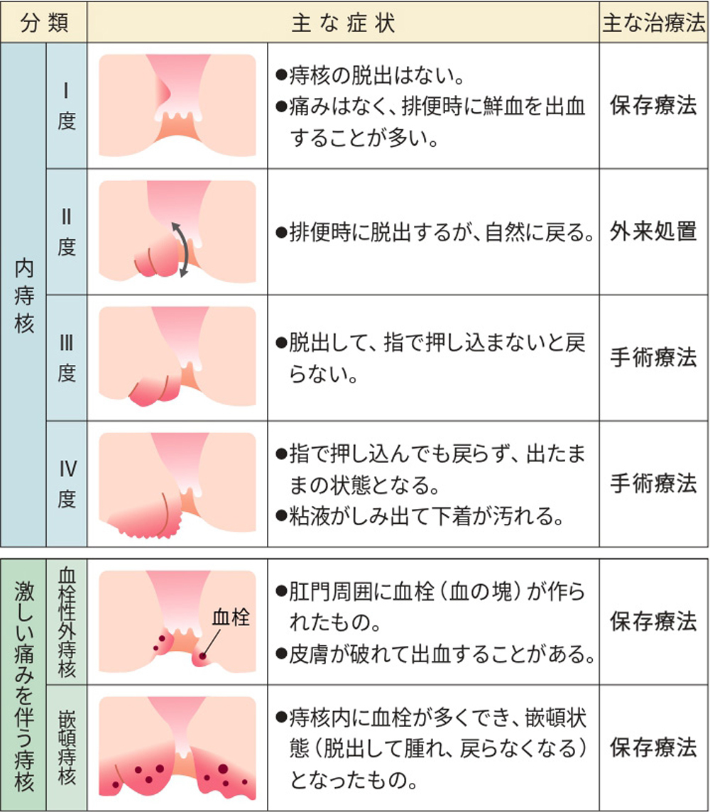 痔の主な症状