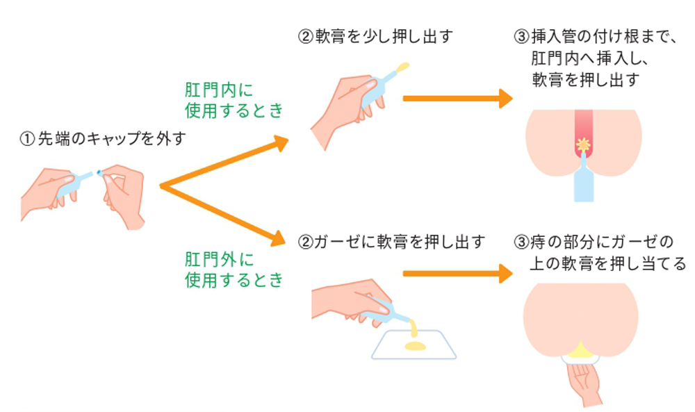 軟膏の使い方