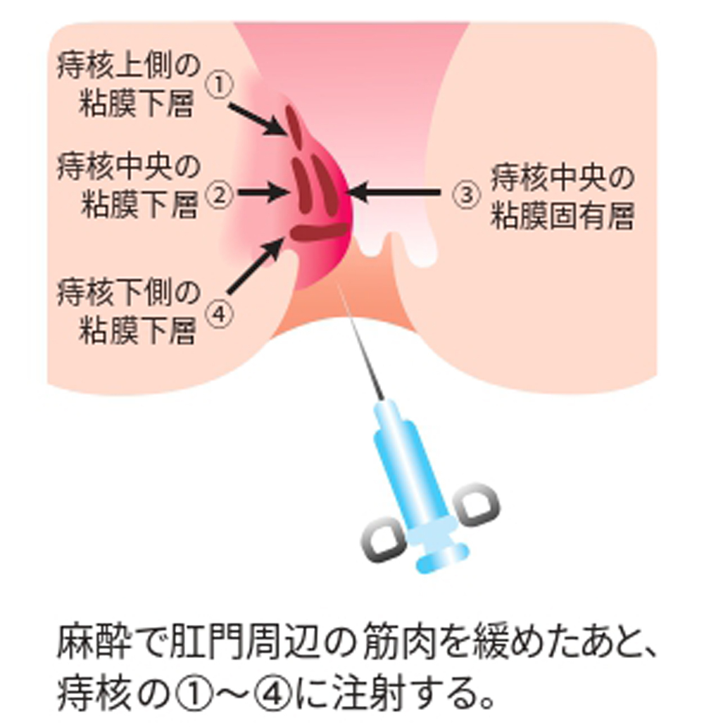 ALTA注