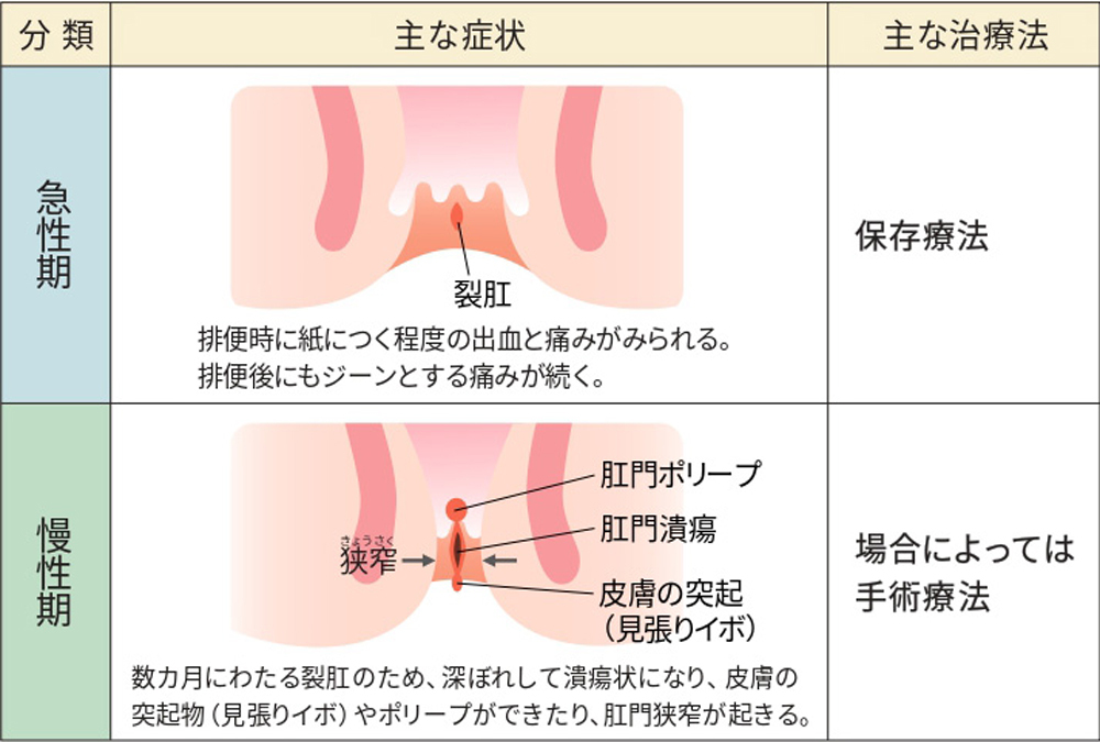 裂肛