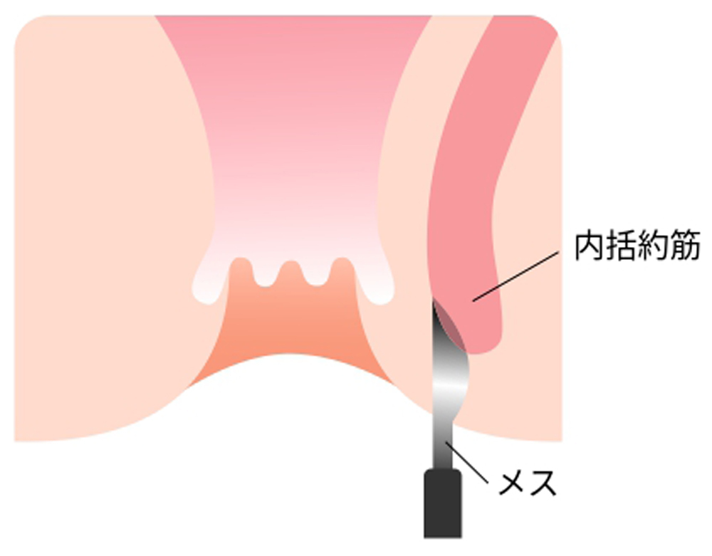 手術療法【内括約筋側方皮下切開術】